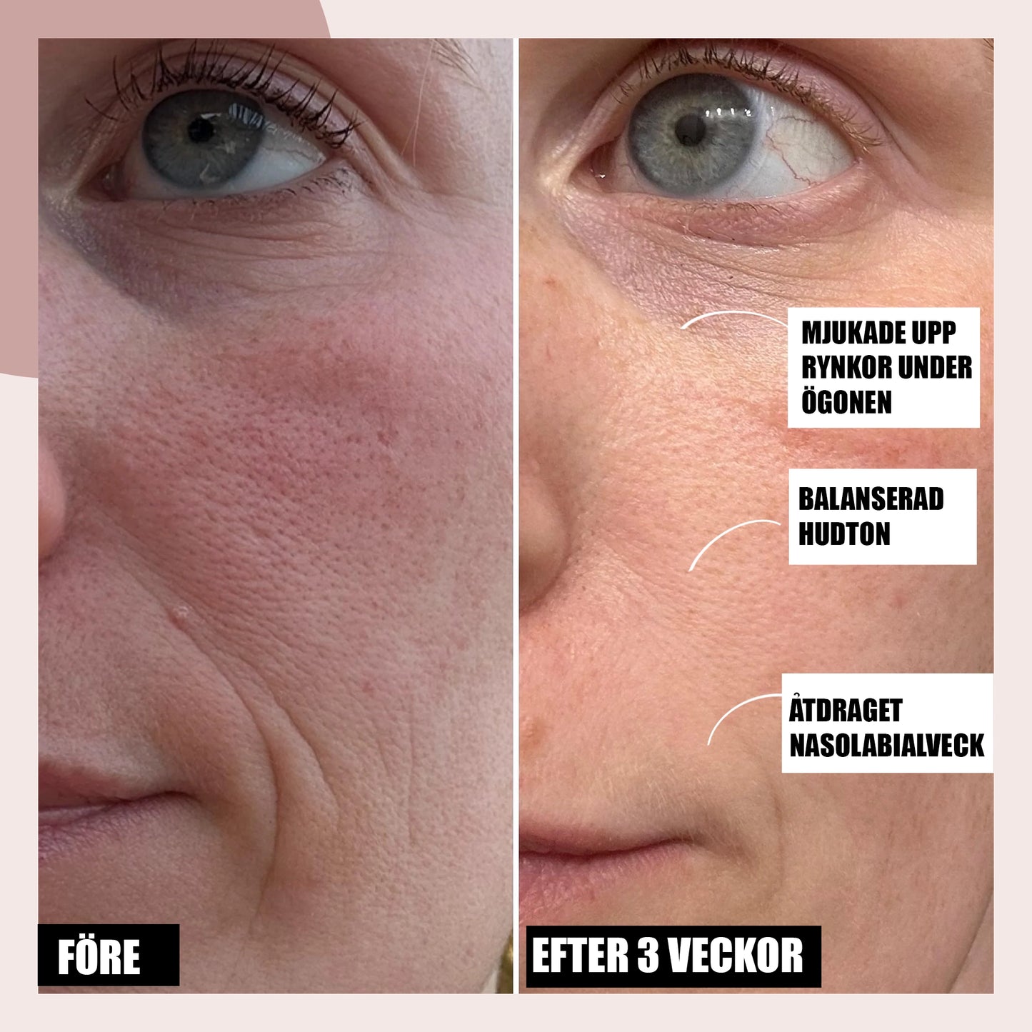 LED-Ljusterapimask för Ansikte med Flera Ljuslägen